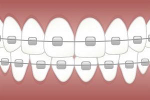 ortodonti tedavisinde kullanılan diş teli ve braketten oluşan bir aparey.